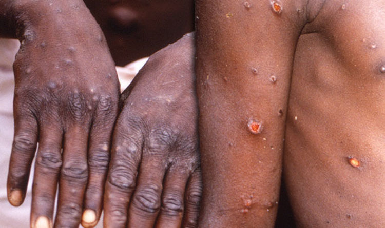 Australia reports first monkeypox case in traveller from Britain